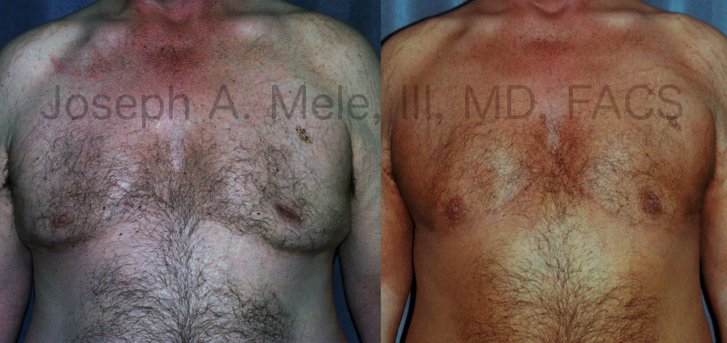 This patient had gynecomastia surgery prior to presenting to my office. Revision gynecomastia surgery was performed including restoration of volume beneath the nipples (left > right) and resection of the excess skin that remained along the lower chest. His scars have had time to heal and are less noticeable; however, individual results will vary. 