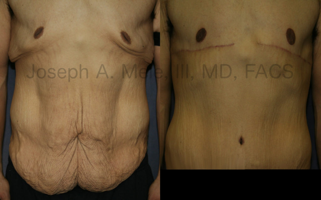 Body Lift after massive weight loss including: chest reduction (massive gynecomastia reduction), areolar reduction, breast lift and abdominoplasty (tummy tuck). The early scars are more noticeable in the first several weeks to months after surgery, but will continue to improve and fade during the year or two after surgery.