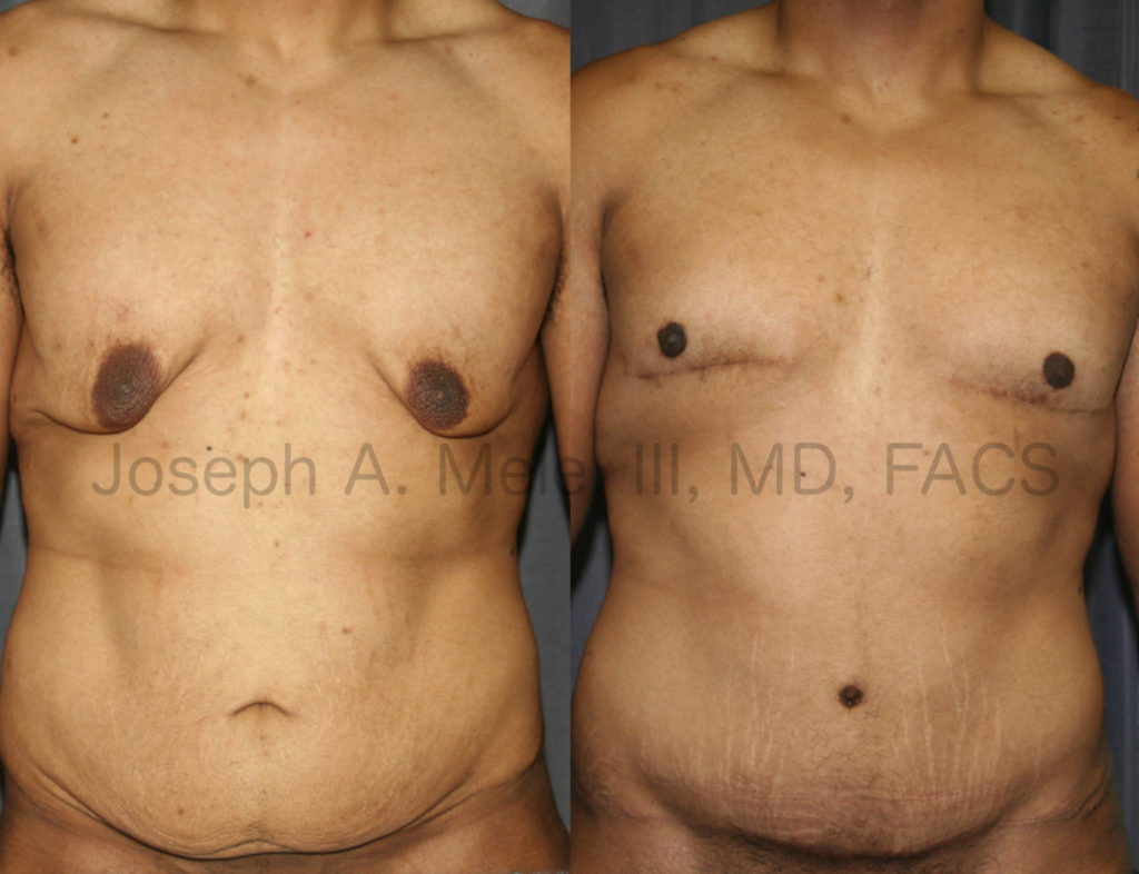 Gynecomastia Reduction after Massive Weight Loss is a different operation than the typical gynecomastia reduction. The large amount of excess skin and extremely low nipple position require special attention to detail and appropriate treatment to achieve a great result. This patient had chest skin reduction (a male breast lift), reduction and repositioning of his nipples along with a tummy tuck to restore his physique after impressive weight loss.