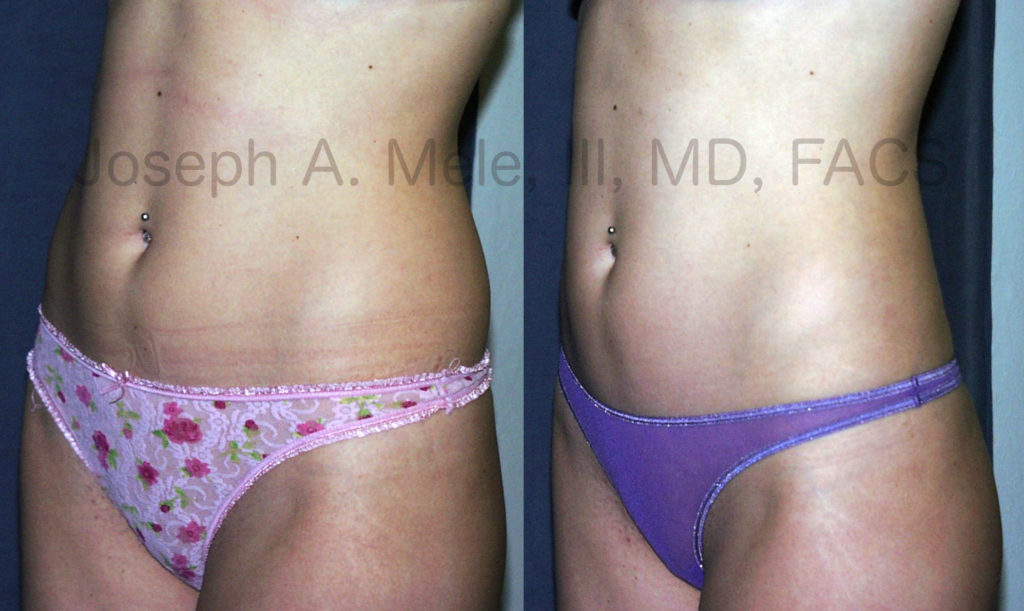As seen in the photo above, disproportionate fat of the sides causes the muffin top, which flows over the top of jeans. Liposuction removes disproportionate fat and flattens the treated area creating a more svelte figure.