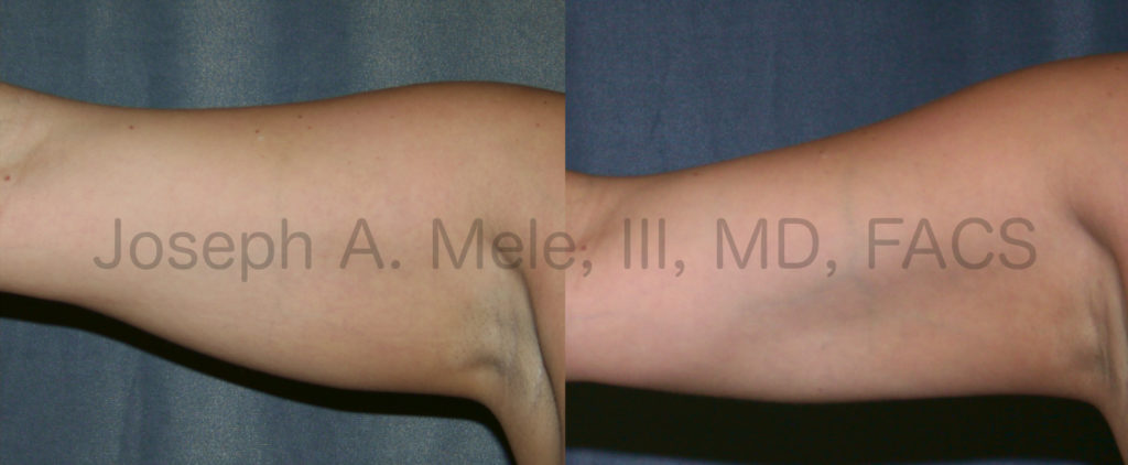 Before and after pictures of arm liposuction reveal smaller arms with better muscle definition after liposculpture.