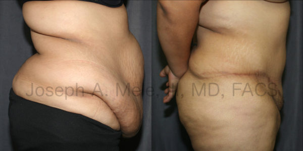 Extended Tummy Tuck Before and After Pictures Post-Bariatric Plastic Surgery