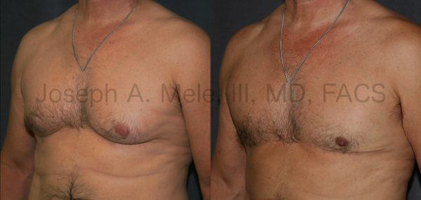 Male Breast Reduction after massive weight loss - post-bariatric plastic surgery  before and after pictures