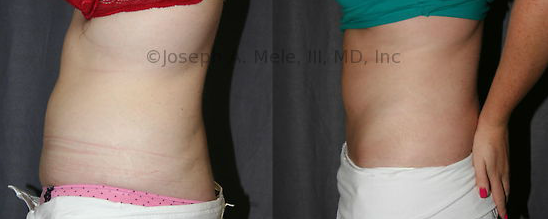 From flabby to fit. A Mini Abdominoplasty was all that was needed to restore this belly. 