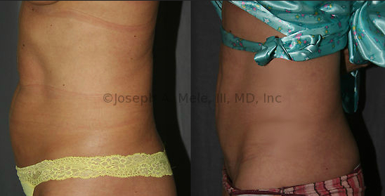 For this bulge at the bottom of the belly, a Mini Tummy Tuck is just what the doctor ordered. 