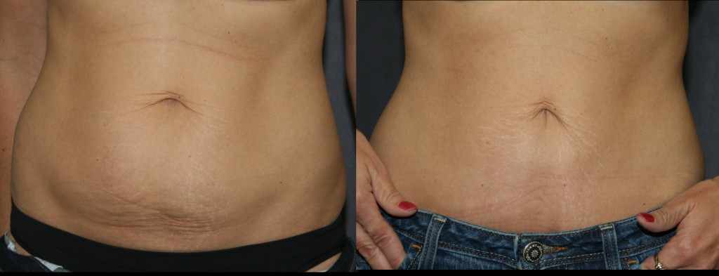 When there is less tummy to tighten, the Mini Abdominoplasty or Mini Tummy Tuck can give great results with a shortened recovery.