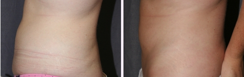 Mini Tummy Tuck (Mini Abdominoplasty) with Liposuction - Before (Left) / After (Right)