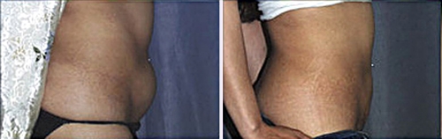 Another Mini Tummy Tuck (Mini Abdominoplasty) with Liposuction - Before (Left) / After (Right)