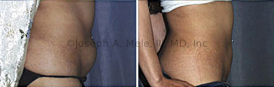 Mini Tummy Tuck - Before and afters reveal significant tightening of the lower abdomen and a more flattering figure.