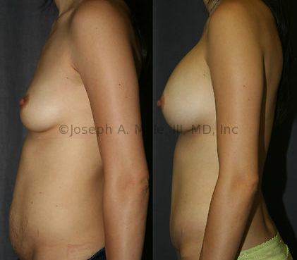 The Mommy Makeover, in this case Breast Augmentation plus a Tummy Tuck, is more often performed for younger women who are finished having children.