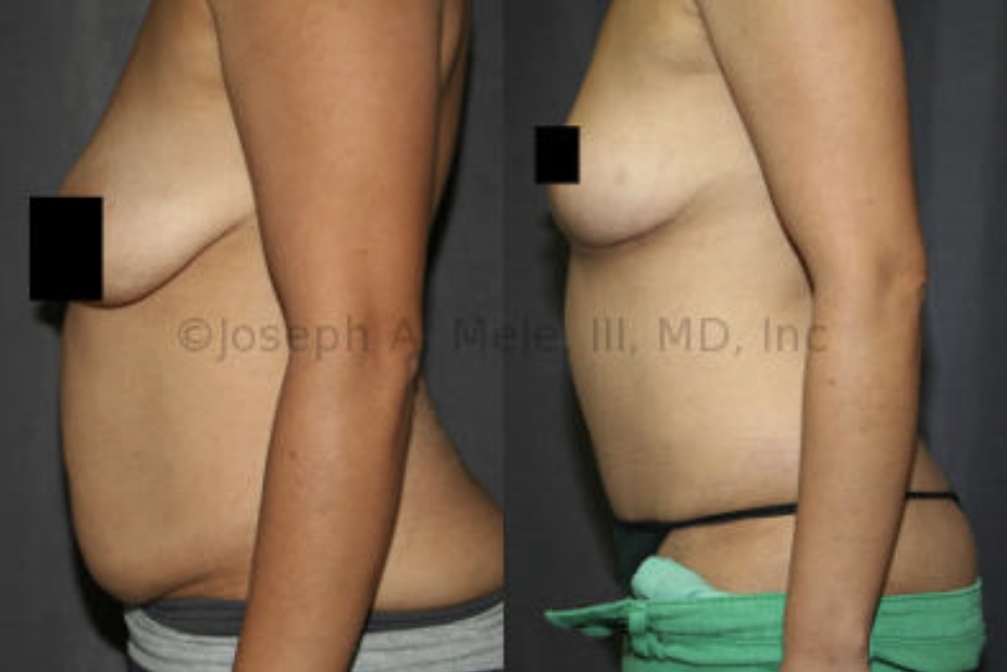 In the above Mommy Makeover, a Tummy Tuck is combined with a Breast Lift. When the size of the breast is satisfactory, and the main problem is sagging, a breast lift can restore the breasts' shape without making them bigger.