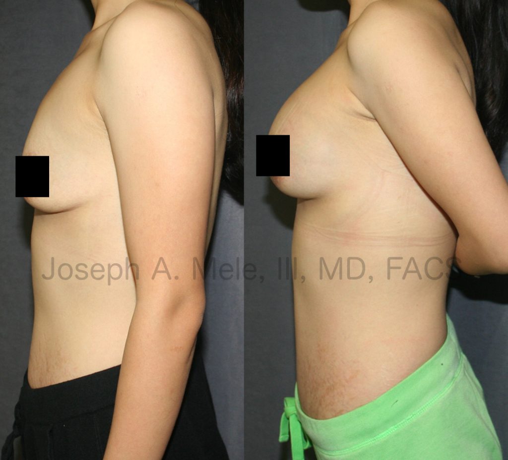 The Mommy Makeover is the most popular, and one of the most satisfying, combination cosmetic plastic surgery procedures. With the ability to reshape the breast and flatten the belly, the Mommy Makeover is the procedure of choice to rejuvenate the female form after pregnancy or weight loss.