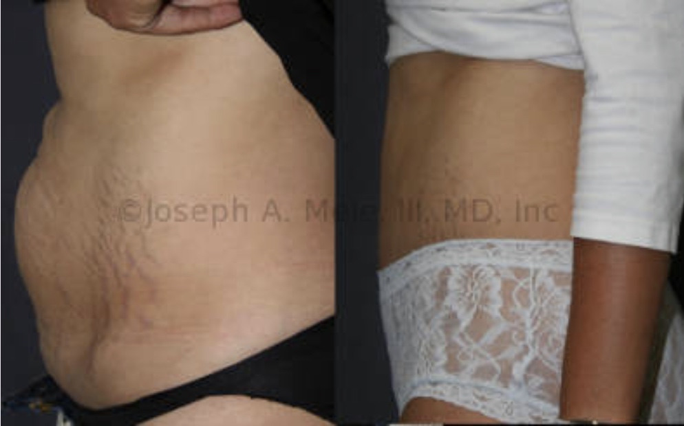 Mommy Makeovers repair both the breasts and belly. Above, a Tummy Tuck is used to flatten and tighten the post baby belly.