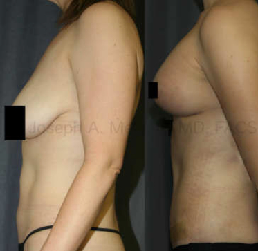 The Mommy Makeover helps by enhancing both the breasts and the belly in a single combination plastic surgery procedure. Above, a Breast Augmentation Lift (Augmentation Mastopexy) is combined with a Tummy Tuck for the optimal result.