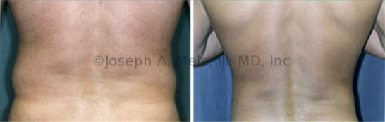 Liposuction of the lower back and flanks removes love handles and the muffin top.