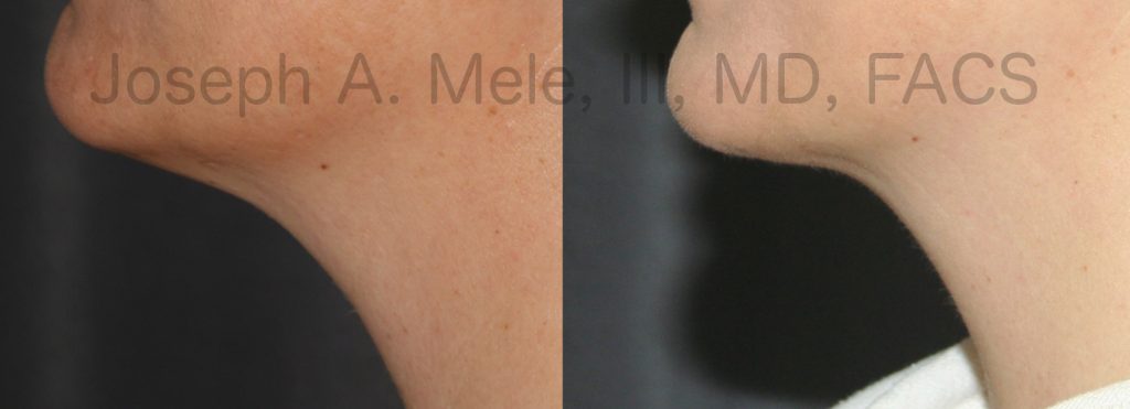 The full neck responds well to Neck Liposuction, as long as the skin tone is good. This is demonstrated by the Neck Liposuction Before and After Pictures shown above.