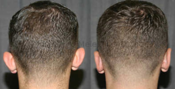 The Otoplasty scar is hidden in the fold behind the ear, allowing the hair to be worn up, or even shaved off with confidence.