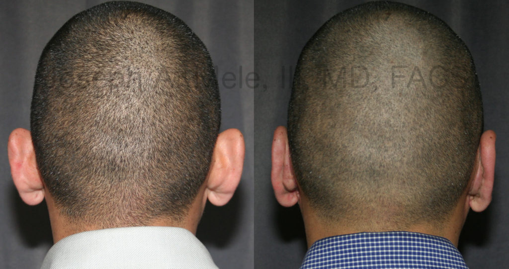 Short hair does not disguise prominent ears. However, since the incisions are hidden in the fold behind the ears, short hair is not a problem for concealing the Otoplasty incision.