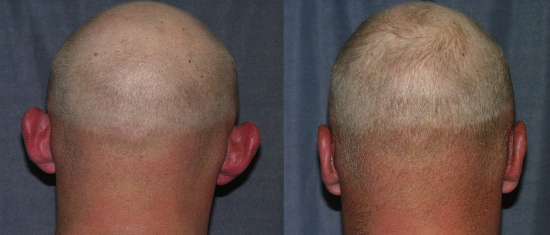 Otoplasty can be performed in adults too. Even the follicly challenged can feel confident that the surgical evidence will be hidden behind their ears.