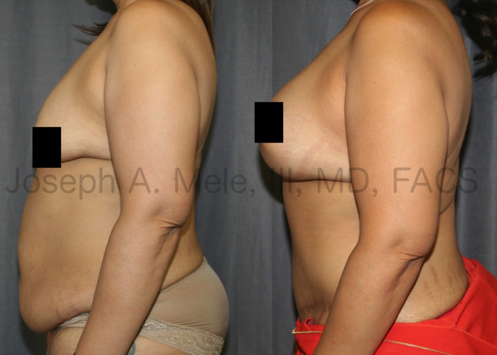 Massive weight loss will shrink our volume, but does not reliably shrink our skin. In the before and after pictures above, breast volume is restored with breast implants. Sagging breast skin is tightened with a breast lift.  Excess abdominal skin is removed, and the belly bulge caused by stretched out abdominal muscles is flattened by tightening the muscle sheath.