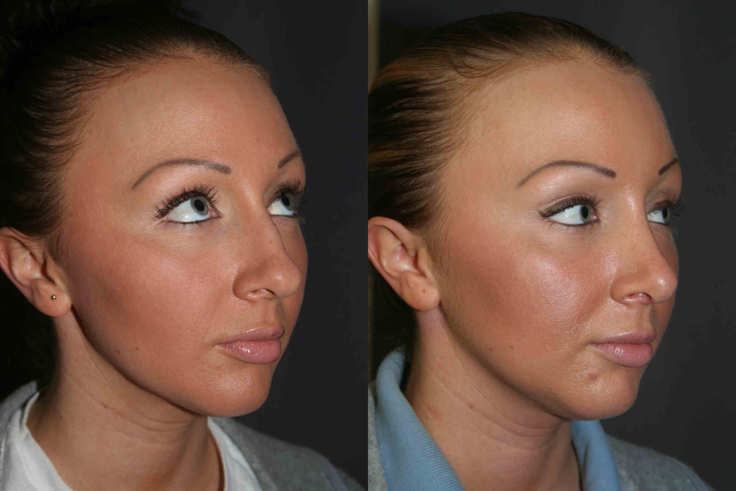 Rhinoplasty Before and After Pictures
