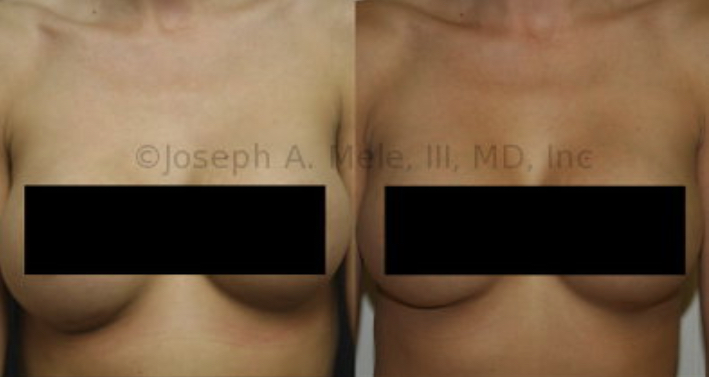 Seromas are collections of fluid. Small amounts of fluid around the breast implants is normal the first few days after surgery and resolves spontaneously. Seromas that appear years after surgery are not normal or common. The fluid will enlarge the effected breast, making it appear larger than its sister breast. It may present as the picture above shows, with the right breasts appearing larger than the left. There are many causes, most of them benign; however, all should be checked by your plastic surgeon. Breast implant warranties are starting to include testing and treatment for late seromas.