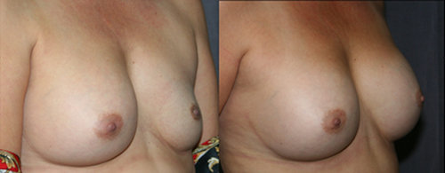 When a breast implant remains deflated for a long time, the skin and the pocket around the implant often shrink. This before and after picture show improved symmetry after breast implant replacement surgery.