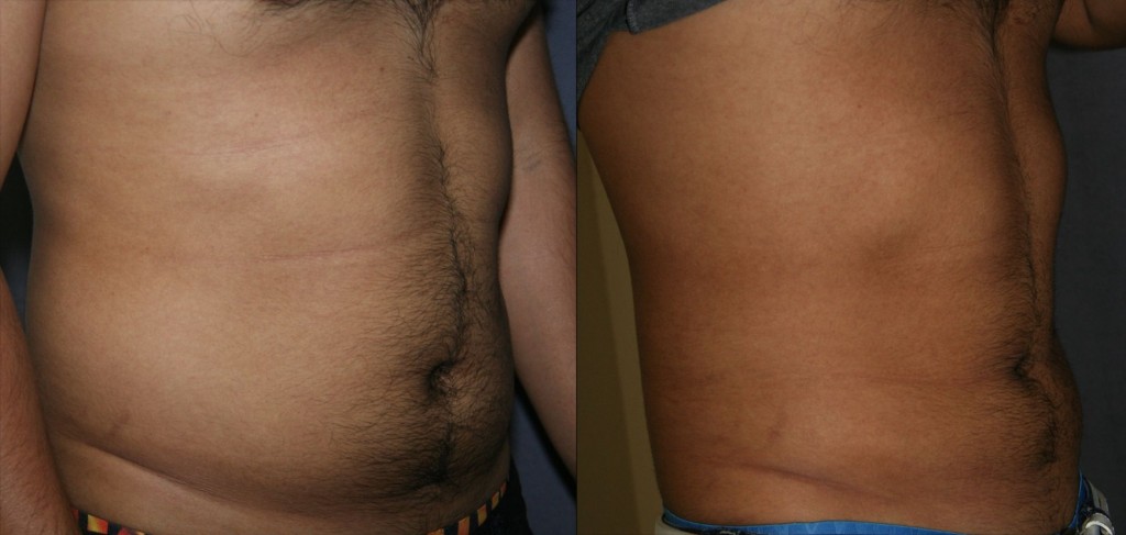 Liposuction of the Abdomen and Flanks - Male