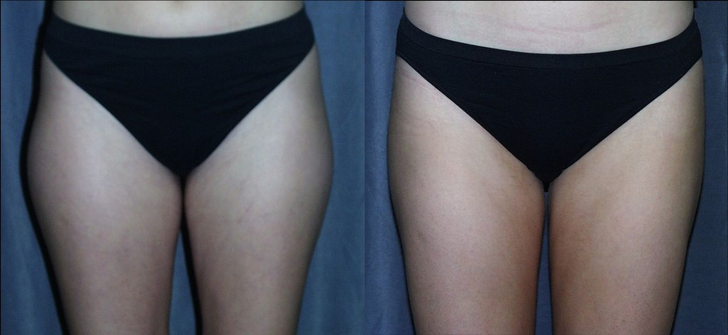 Liposuction of the Thighs