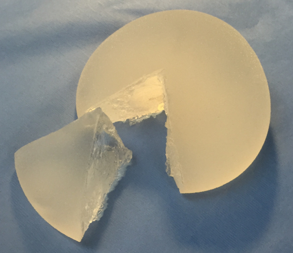 Silicone gel filled breast implants have evolved over the last few decades. The latest options provide soft, strong implants filled with a cohesive, gummy-bear gel to reduce the possibility of gel migration.
