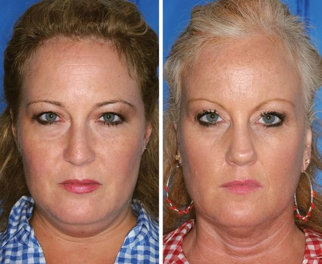 Can you tell which twin smokes? If you guessed the twin on the right, you are correct. Compared to her non-smoking sister in blue, the twin in red has advanced signs of aging including: marked loss of mid and lower face fullness, deeper nasolabial folds and smoker's lines around the lips.