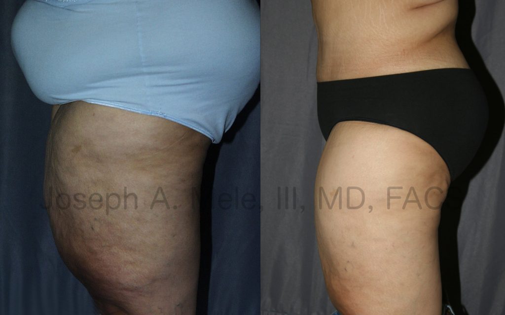 Thigh Lifts are most often performed after massive weight loss or bariatric surgery. They can be combined with other skin tightening procedures, such as an abdominoplasty in this case.