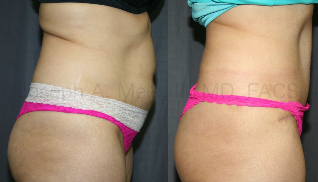 The Tummy Tuck can increase the support for the belly and the back.