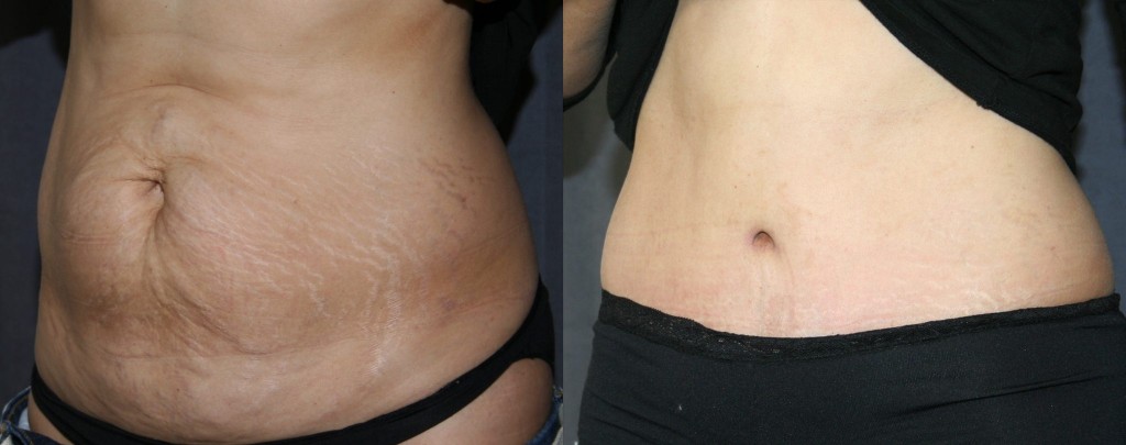 Tummy Tuck - Before and After Picture