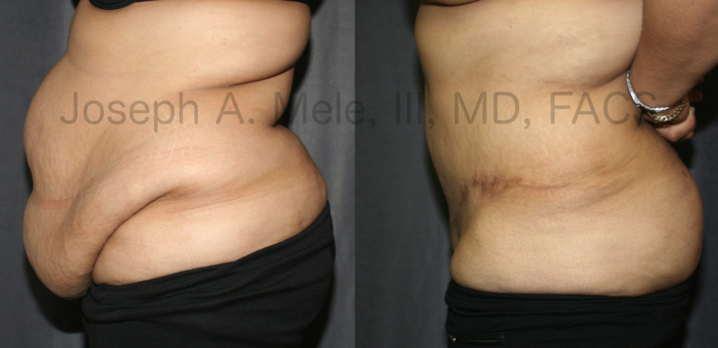 Post Bariatric Plastic Surgery - Tummy Tuck Before and After Pictures