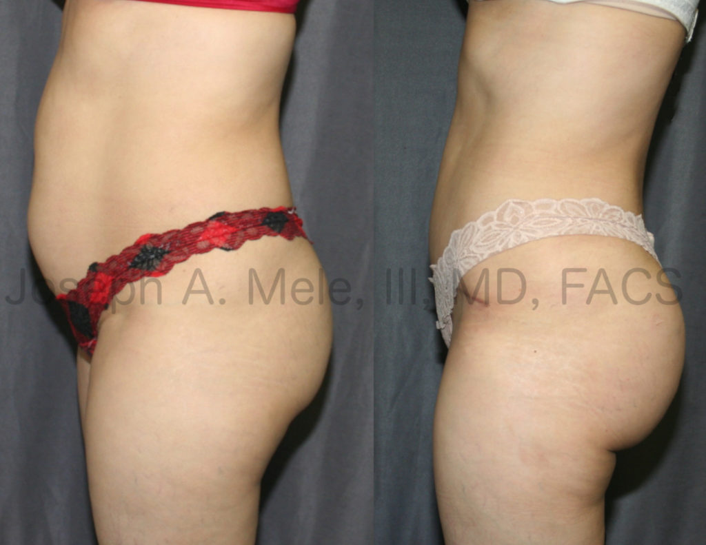 Tummy Tuck with Brazilian Butt Lift Before and After pictures 