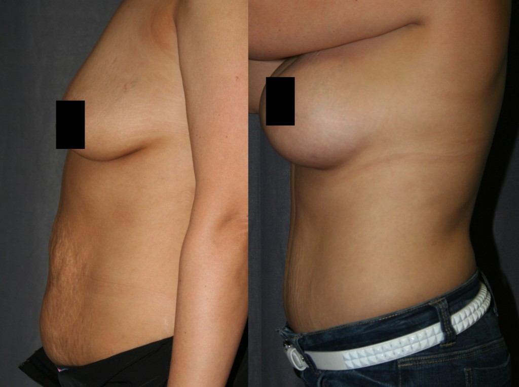 These Mommy Makeover before and after photos display the most popular combination of belly and breast enhancement: The Tummy Tuck (Abdominoplasty) with Breast Augmentation (Breast Implants).