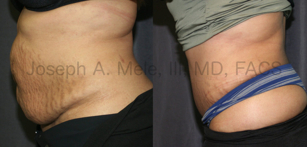 Tummy Tuck Before and After (Abdominoplasty)
