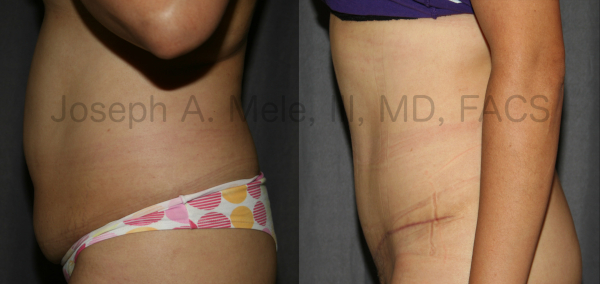 Tummy Tuck Early Scar