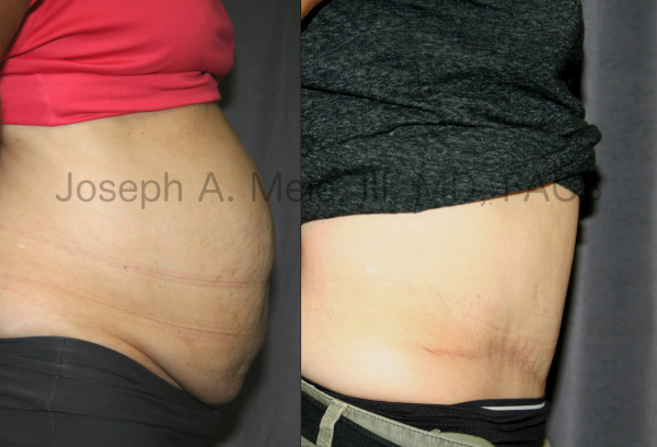 Abdominoplasty After Babies