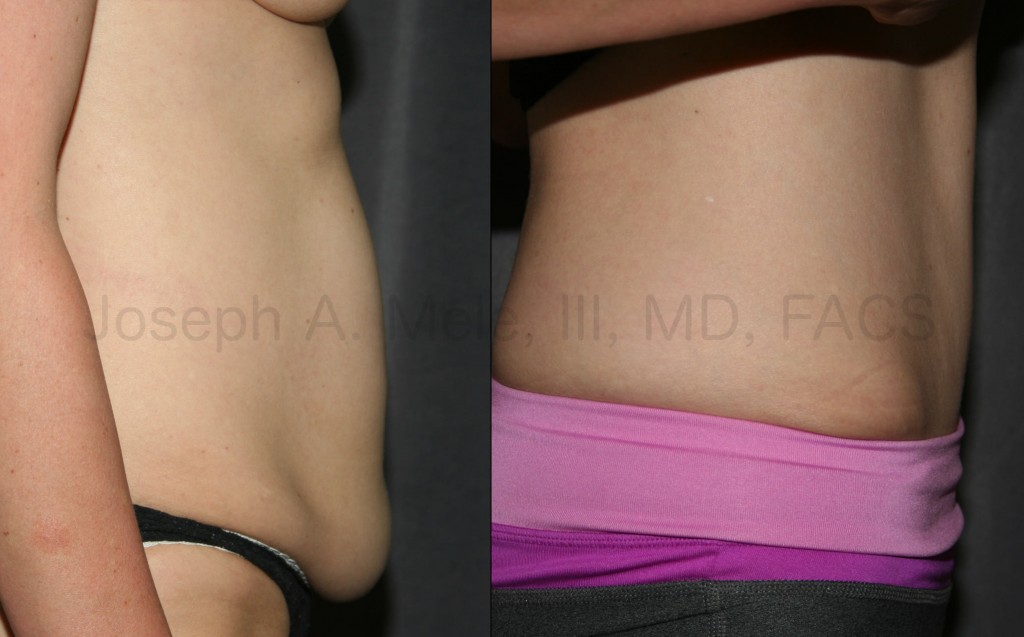 The Tummy Tuck provides excellent cosmetic results, but there may be medical benefits, also.