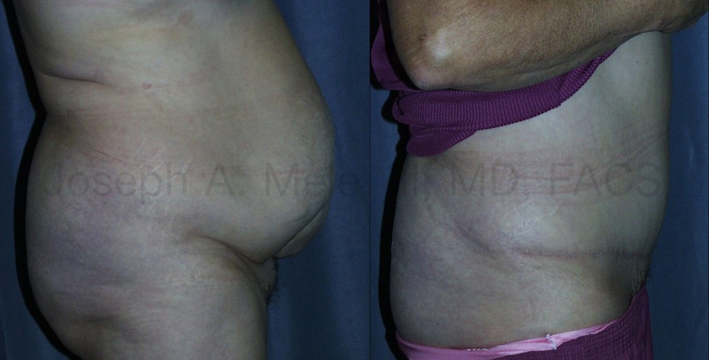 Abdominoplasty makes ventral hernia repairs can be made safer and more secure.