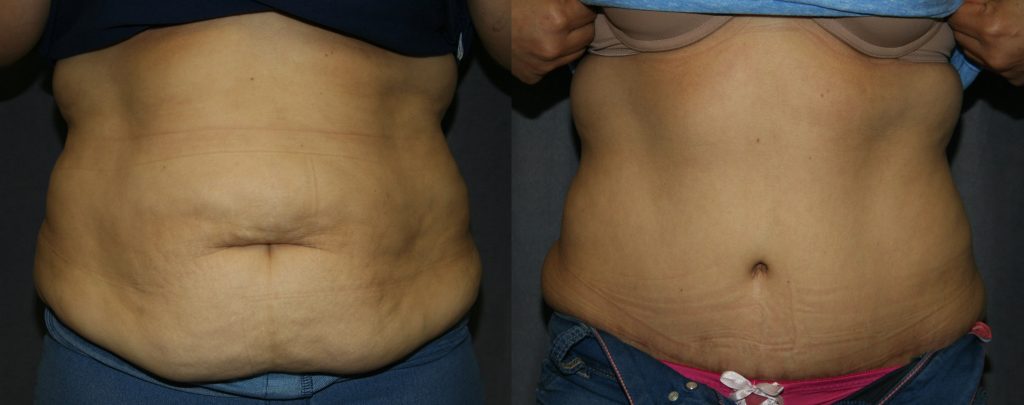 Abdominoplasty Before and After Pictures: The front view of the above Abdominoplasty shows how much the abdominal muscles and skin are tightened. The shadows of the muscles are brought closer to the midline and skin is much smoother. The belly button is also rejuvenated. 