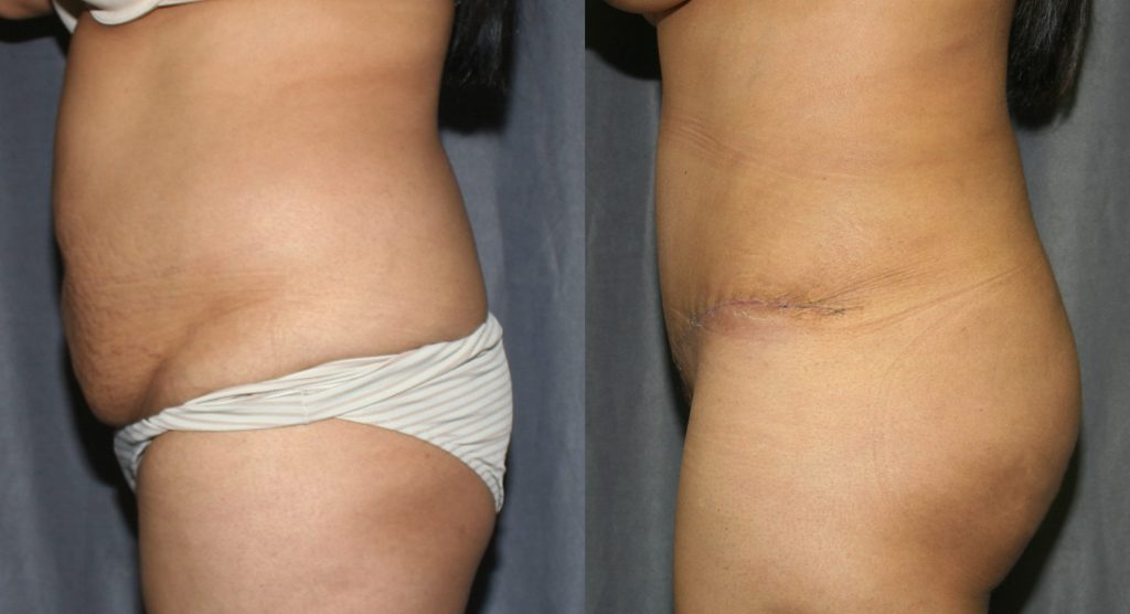 Tummy Tuck and Brazilian Butt Lift Before and After Pictures: In this case, Abdominoplasty is combined with Liposuction of the back and flanks. The fat is harvested and grafted into the buttocks to create fuller, curvier buttocks.