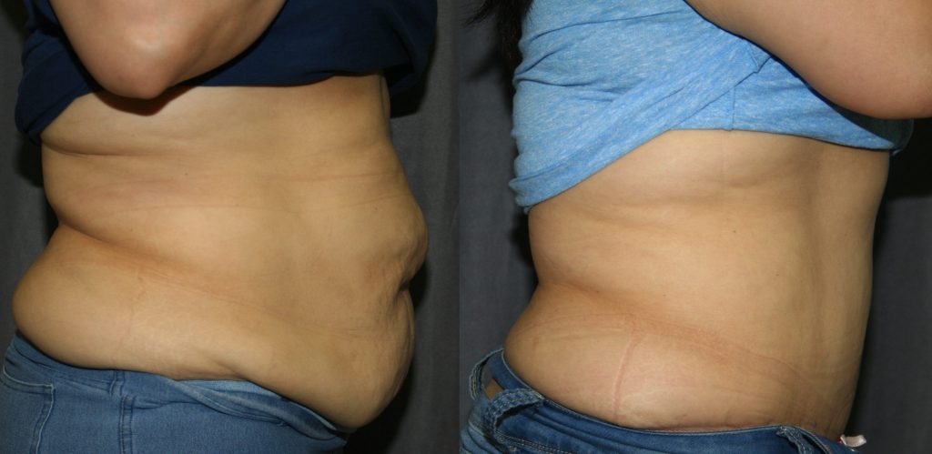 Tummy Tuck Before and After: These side views of Abdominoplasty before and after pictures show what a Tummy Tuck can do to address overstretched abdominal muscles and abdominal skin laxity seen after pregnancy or weight loss.