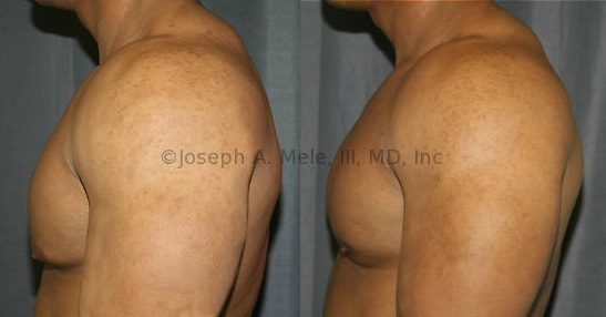 Gynecomastia Reduction provided smaller areolae, improved symmetry, elevation of the nipple and removal of the stigma of possible steroid use. The difference in projection of the tissue beneath the nipple, before and after gynecomastia surgery, is obvious on this lateral view.