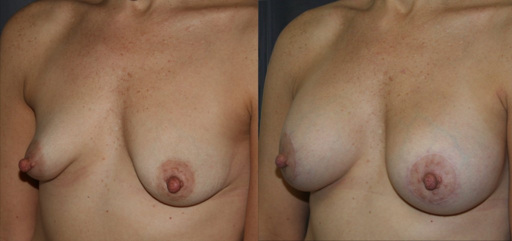 Tubular Breast Augmentation Lift