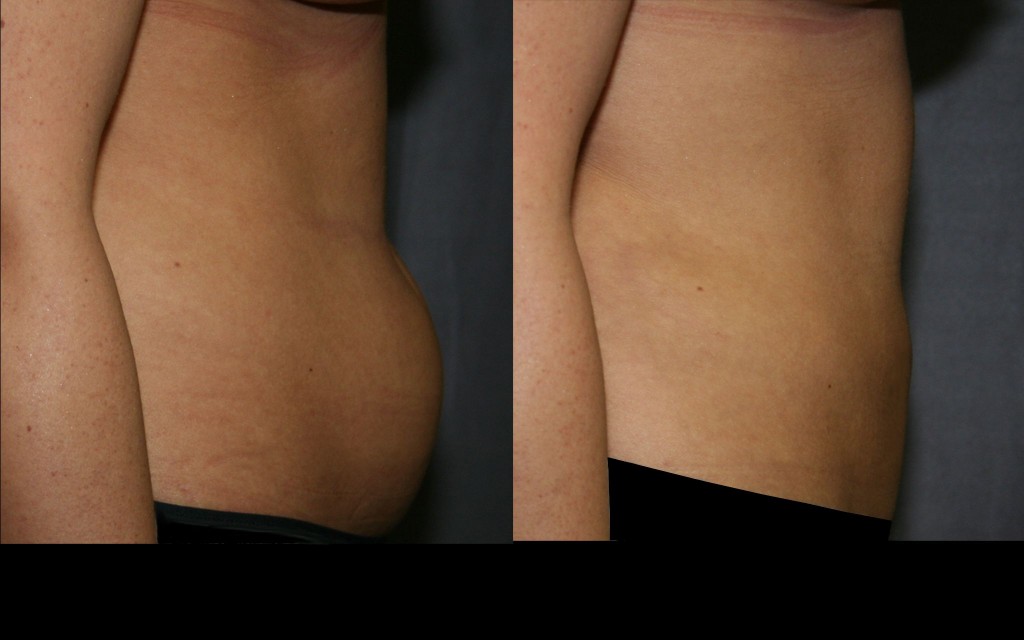 Tumescent Liposuction