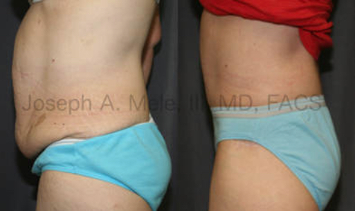 Even after the weight loss, the abdomen may appear loose or full. This case shows what a full abdominoplasty, including muscle tightening, can do for a flaccid belly.
