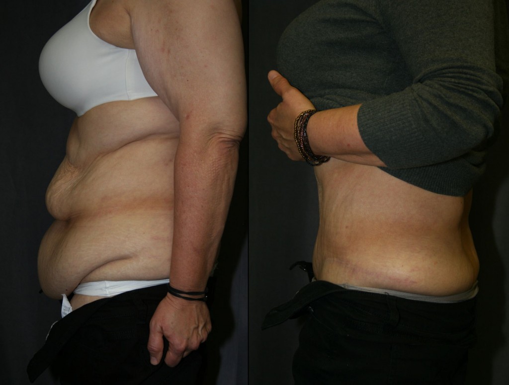 SmartLipo does not shrink skin like a tummy tuck can. Above, multiple folds of redundant skin are smoothed, improving how the belly looks and how clothes fit. 